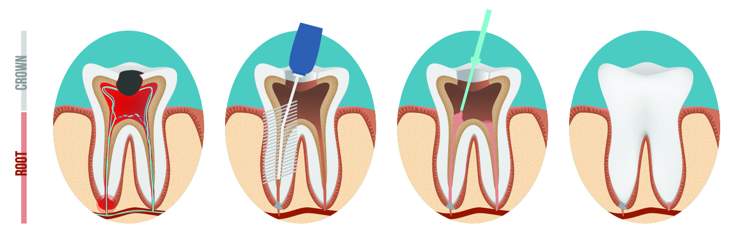 Diagram of how a root canal is done at 9th Ave Dental in Calgary Downtown
